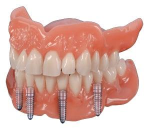 Complete Mouth Rehabs with Implants