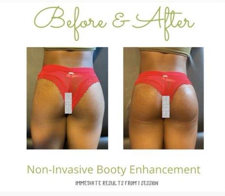 Non invasive butt enhancement helps plump and lift your butt