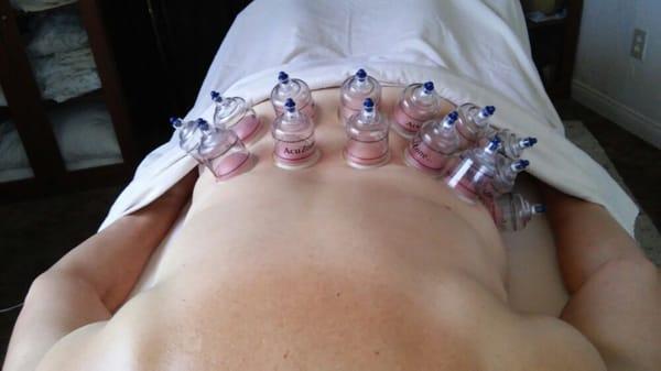 Cupping session