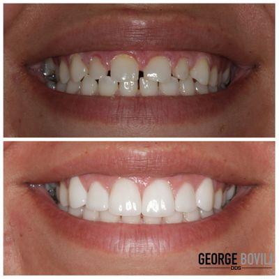 I performed this smile transformation for my patient with a gum lift procedure followed by placement of 6 porcelain veneers.