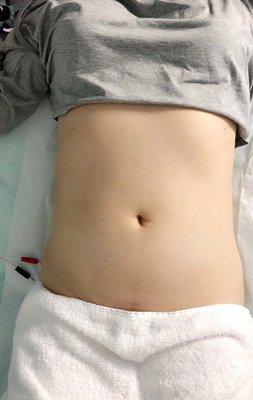 Microcurrent Body Transforming Treatment Before