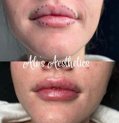 Hyaluron lips - noninvasive filler