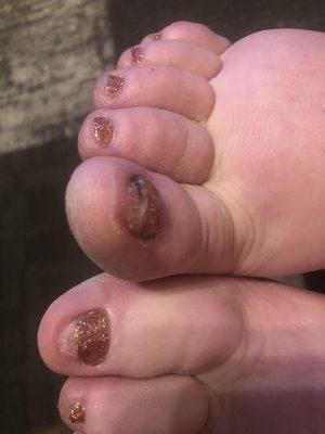 Damaged toe nails