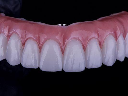 Front view of a full arch zirconia, All on X implant