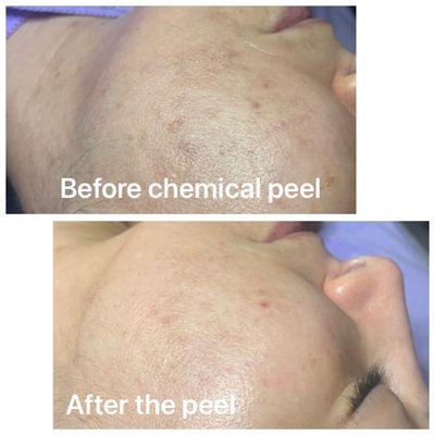 Chemical peels