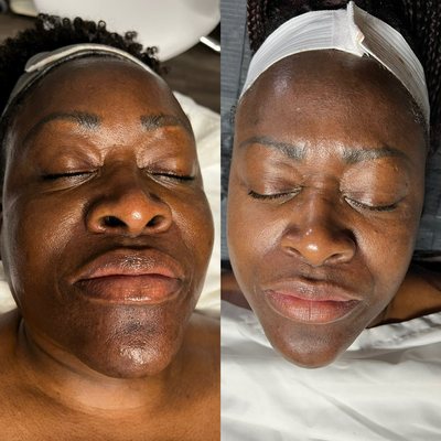 Chemical Peel transformation