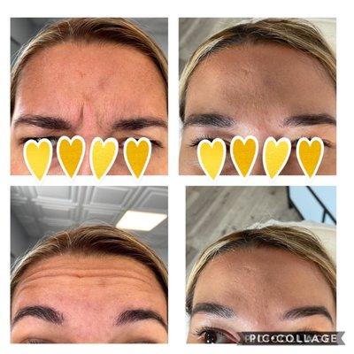 Anti wrinkle treatments