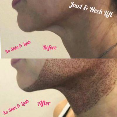 Jowl & Neck Lift!