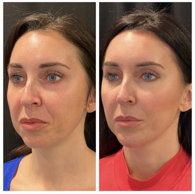 Look at this transformation! Kati helped this beauty feel more confident with a jawline contour. The results are incredible!