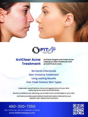 Acne laser solution - no medications with side effects