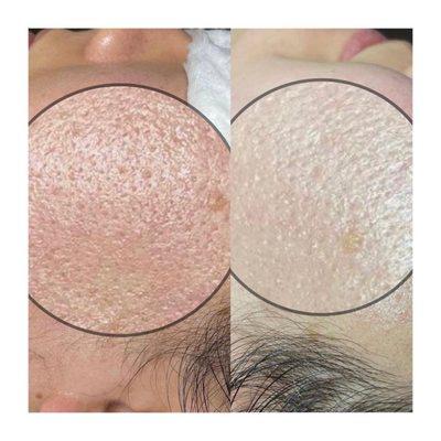 Pores refined