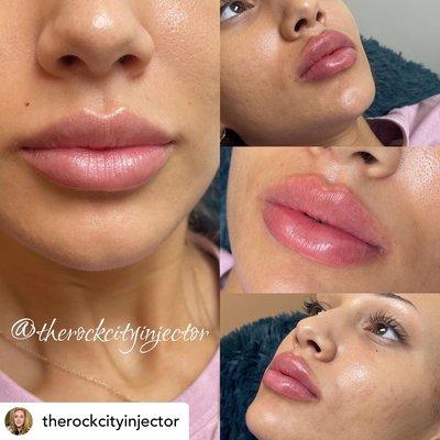 We love this full lip! Randi helped this beauty achieve this gorgeous full lip.