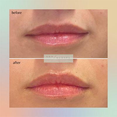 Before and after lip filler