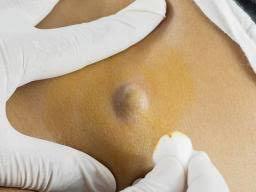 Abscess and cyst removals