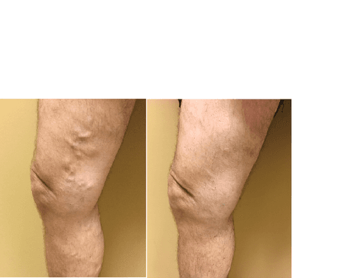 Varicose Veins
Before and After Treatment