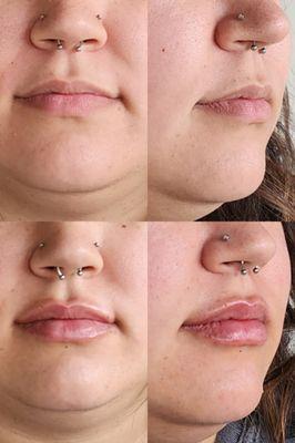 Filler: Lips