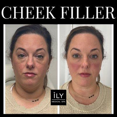 Cheek Filler