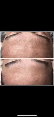 Forehead lines before and after one Hydrafacial treatment