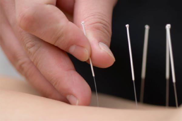 Dry Needling