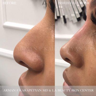 An amazing non-surgical rhinoplasty with dermal fillers by Arman F Karapetyan, MD.