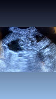 Head measurement ultrasound