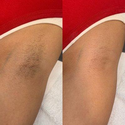 Underarm Sugaring