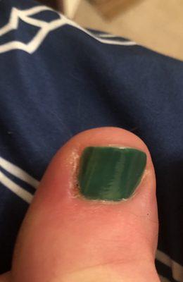 Sliced nail bed wide open