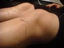 Acupuncture on the knee