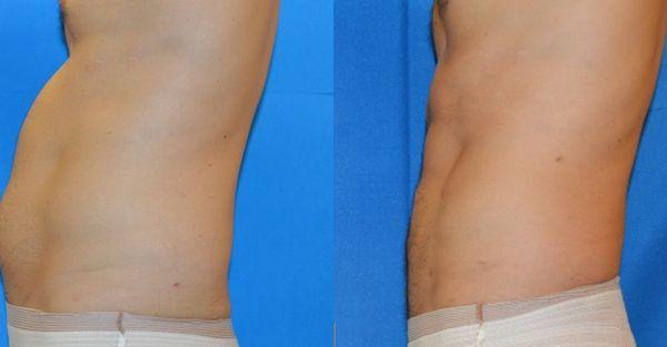 Side profile abdominal and 'lovehandle' fat removal with abdominal etching