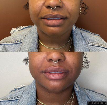 Lips and smile line filler