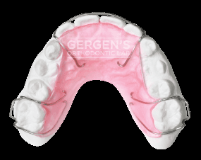 HS1 Retainer fabricated in the USA by David Gergen from Gergen's Orthodontic Lab