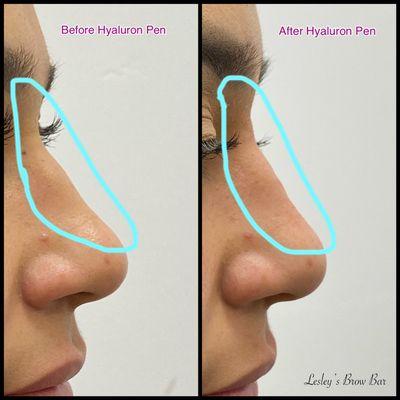 Hyaluron Pen Needle-less Filler on Nasal Bridge