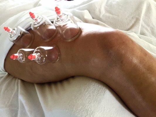 Cupping to reduce the swelling from ACL surgery