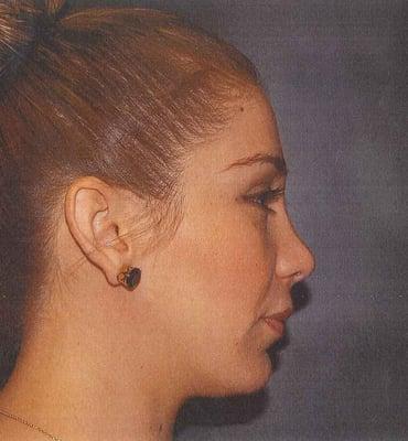 Our Real Patient- After Rhinoplasty