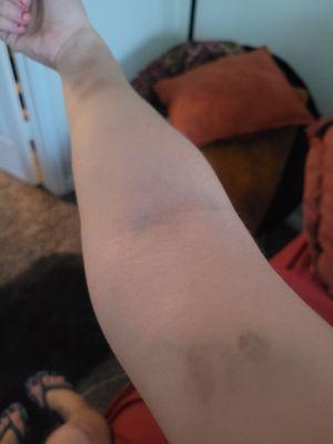 More bruises from carrying items they should've.