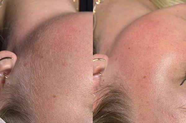 Before & After: Dermaplaning treatment, can be added on to any of your facials. Included in your Glass Skin Facial.