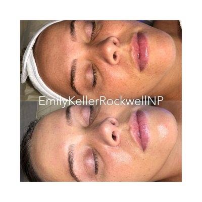 Before and after our medical grade Hydrafacial Treatment using ZO Skin Health.