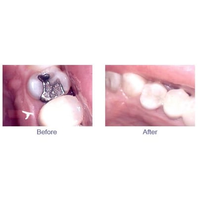 Dental Fillings