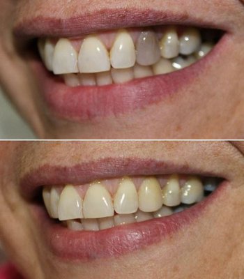 Whitening before and after