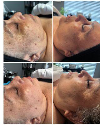 Before and after a Oxygen Facial