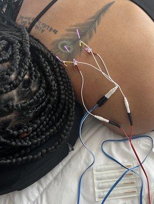 Dry Needling