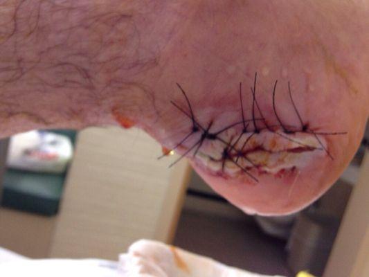 Partial calcanectomy due to decubitus chronic ulceration heel