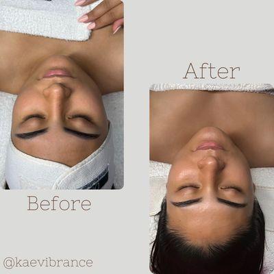 Hydrodermabrasion Facial