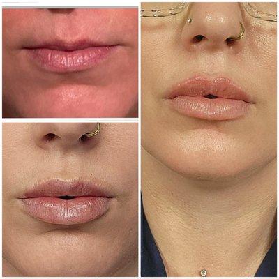 Before and After Lip Fillers