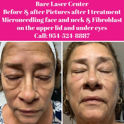 Non invasive treatment!! Impressive results with Fibroblast on the upper lip and under the eyes and Microneedling!