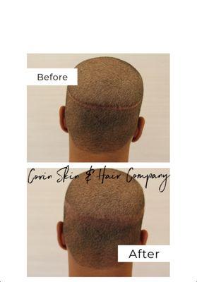 Micro Scalp Pigmentation