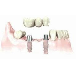 Multiple Dental Implants