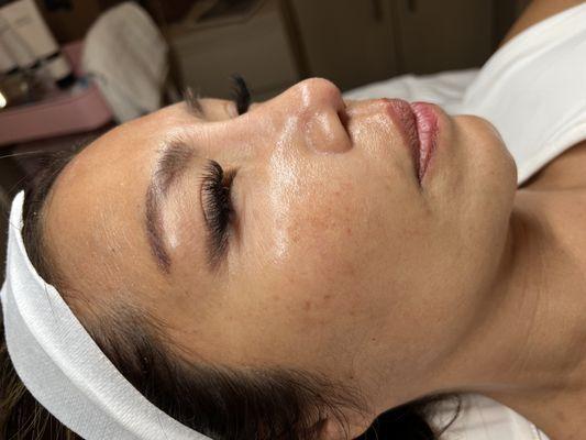 Volume Lashes and results after one chemical peel!