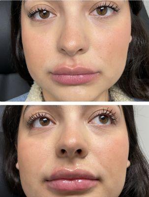 lip fillers, botox