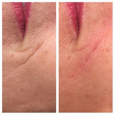 Another example of dermal filler wrinkle reduction